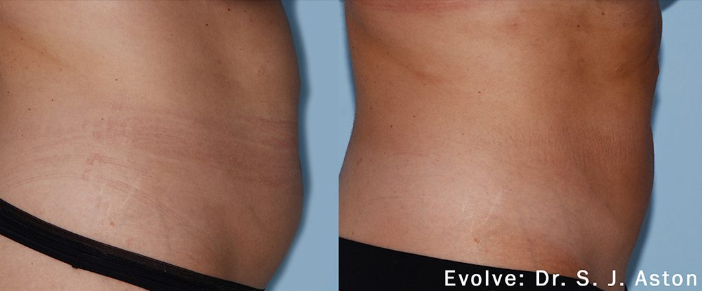 Evolve_2a_abdomen