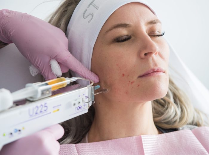 Vampire Facial u 225 Vampire Facial u 225