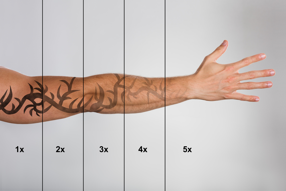 Laser Tattoo Removal - Burlington Medical